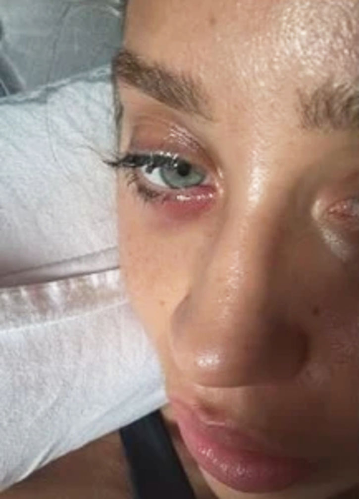 Zeynep Alkan Göz Ameliyatı Geçirdi: Alt Göz Kapağı Kisti Sebebiyle Operasyon